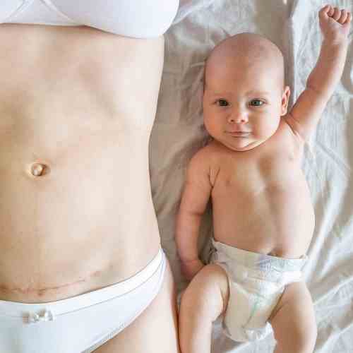 facts about c-sections or cesarean births