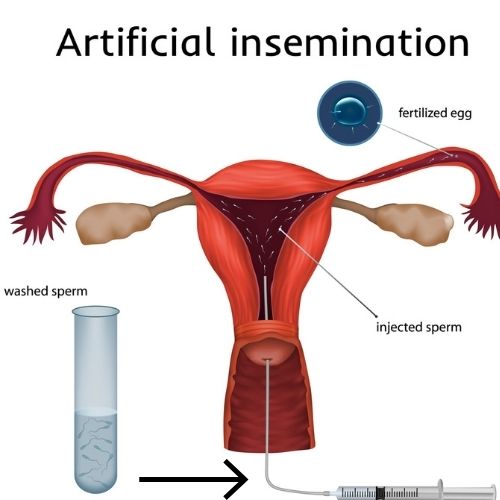 intrauterine insemination process