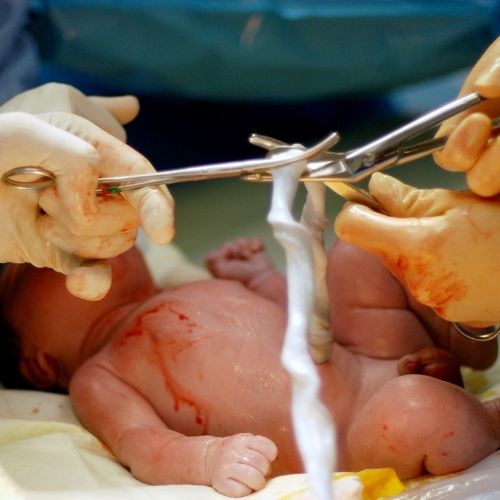 baby with umbilical cord being cut 
